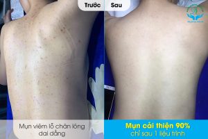 Dịch vụ điều trị mụn viêm lỗ chân lông vùng lưng tại Phòng khám da liễu Hà Nội
