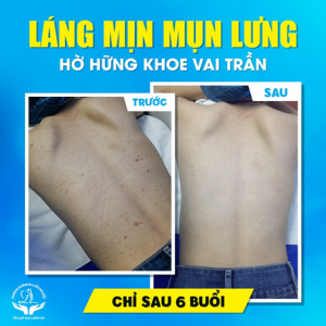 Điều trị mụn viêm vùng Lưng tại Phòng khám da liễu Hà Nội