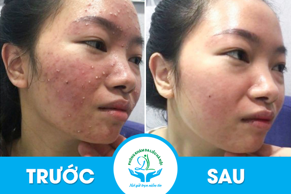 Bệnh nhân trước và sau khi điều trị mụn bọc tại phòng khám da liễu Hà Nội