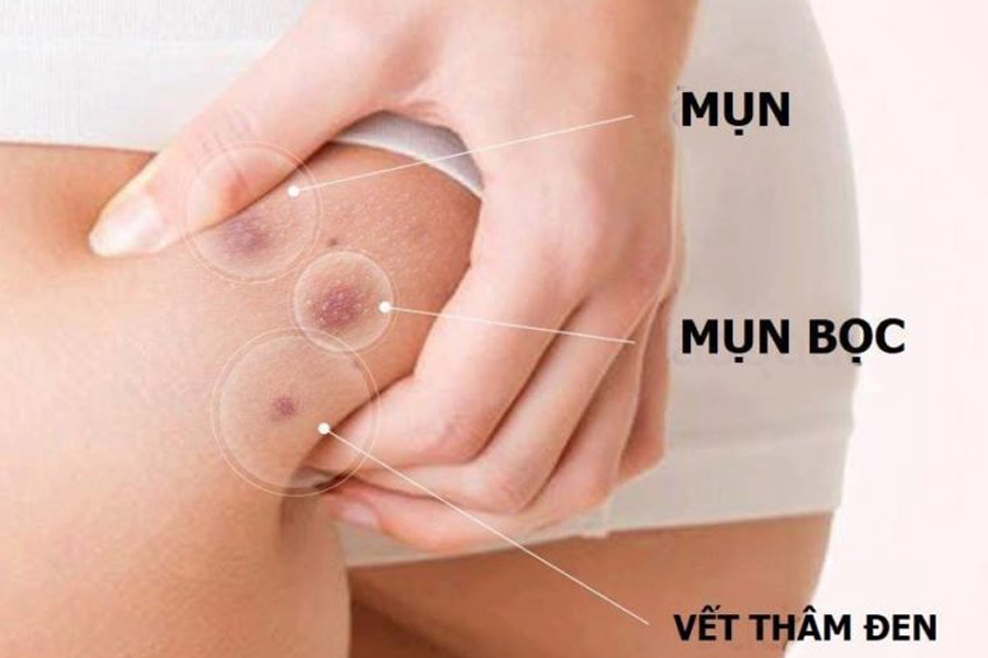 cách  trị mụn bọc sưng đỏ ở mông không thể bỏ qua
