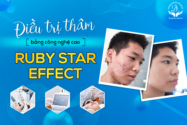 Điều trị thâm bằng công nghệ cao Ruby Star Effect