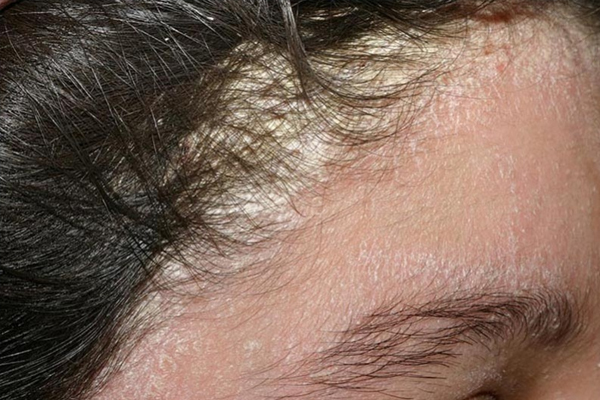 Nấm da đầu là bệnh lý xuất hiện nhiều khi thời tiết nồm ẩm