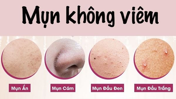 Các loại mụn không viêm thường gặp