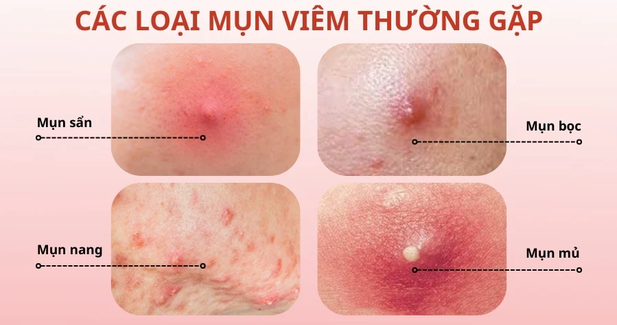 Các loại mụn viêm thường gặp