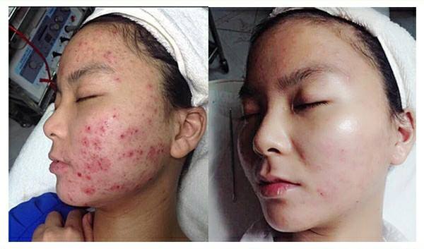 Trường hợp khách hàng da bị nhiễm Corticoid khi sử dụng sản phẩm trị mụn được Phòng khám da liễu Hà Nội chữa trị