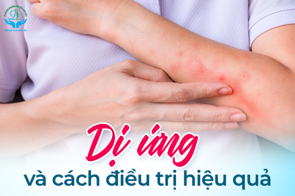Dị ứng và cách điều trị hiệu quả