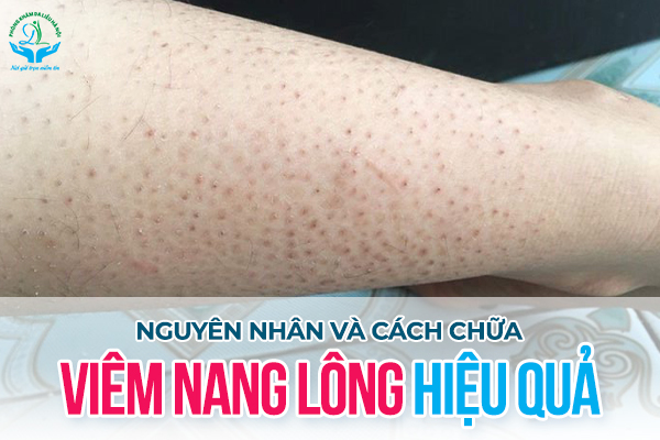 Nguyên nhân và cách điều trị bệnh viêm nang lông
