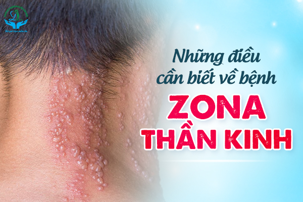 Những điều cần biết về bệnh Zona thần kinh