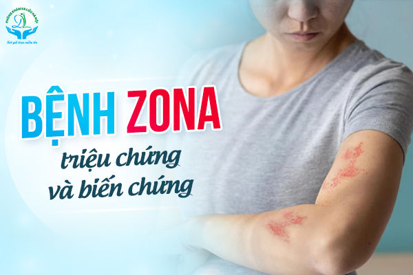 Bệnh zona: Triệu chứng và biến chứng
