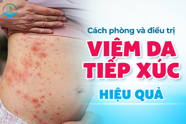 Cách phòng và chữa trị viêm da tiếp xúc triệt để