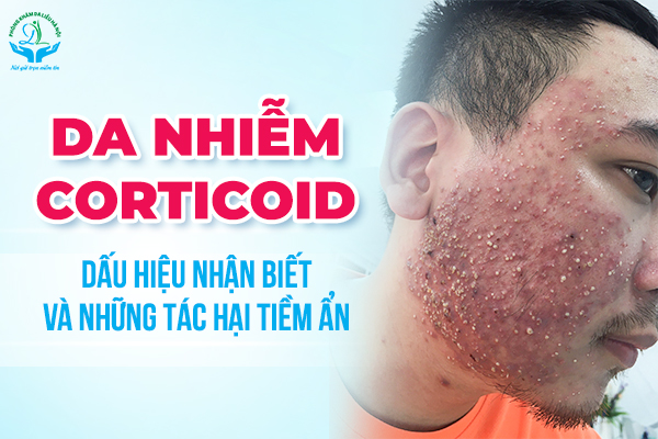 Cách nhận biết da nhiễm độc corticoid & tác hại corticoid 