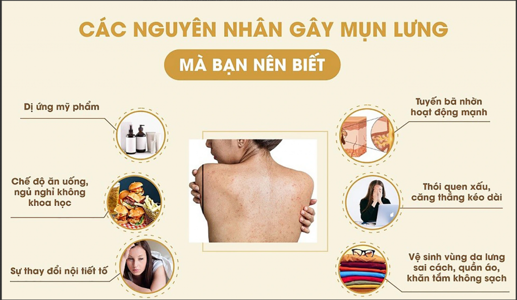 Điều trị mụn lưng lâu năm hiệu quả nhanh nhất