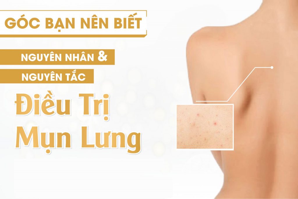 Điều trị mụn lưng lâu năm hiệu quả nhanh nhất