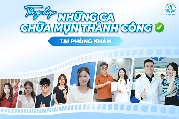Tổng hợp những ca chữa mụn hiệu quả tại Phòng khám