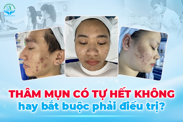 Thâm mụn có tự hết không?