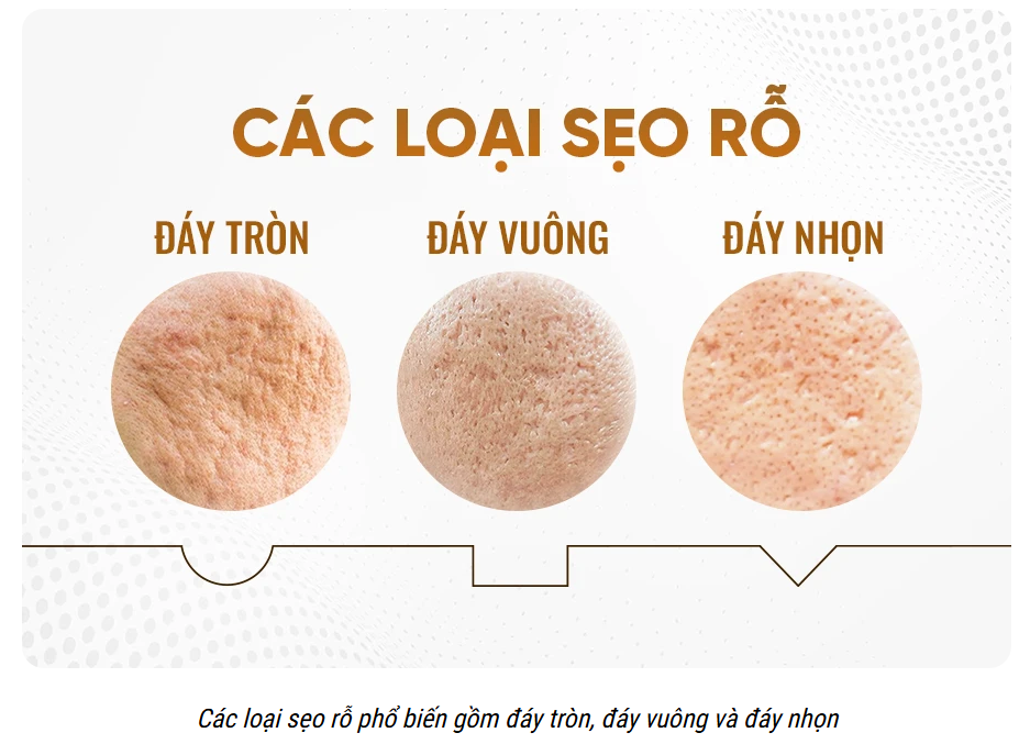 Các loại sẹo rỗ