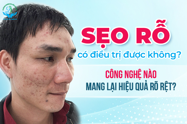 Trị sẹo rỗ do mụn | Phòng khám Da Liễu Hà Nội