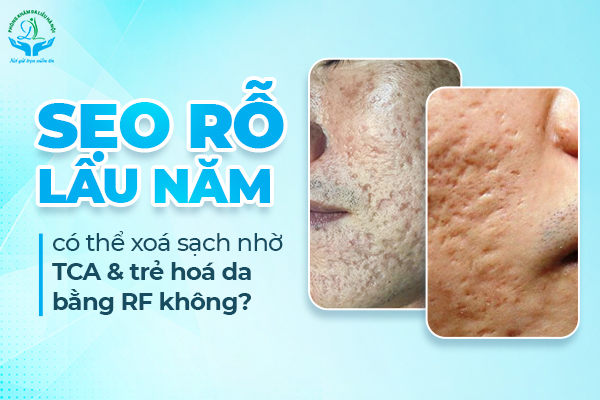 Sẹo rỗ lâu năm có thể điều trị bằng TCA và trẻ hóa da RF không?
