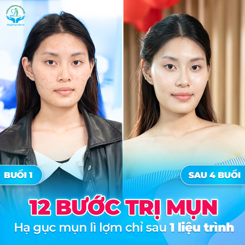 Mụn ẩn