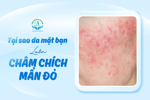 Tại sao da bạn luôn châm chích, mẩn đỏ? 