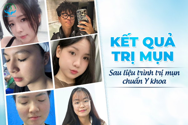 Kết quả trị mụn sau liệu trình chuẩn Y khoa