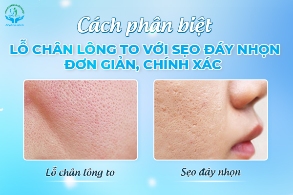 Cách phân biệt lỗ chân lông to với sẹo đáy nhọn đơn giản, chính xác 